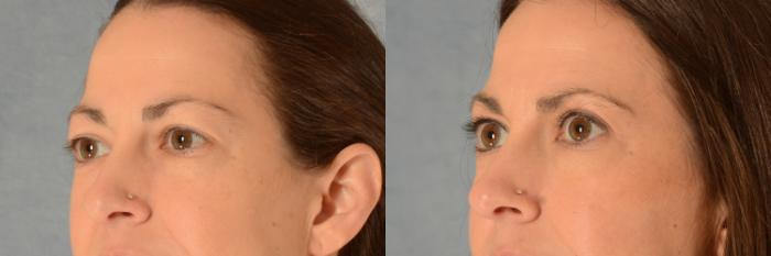 Before & After Eyelid Surgery (Blepharoplasty) Case 511 Left Oblique View in Tallahassee, FL