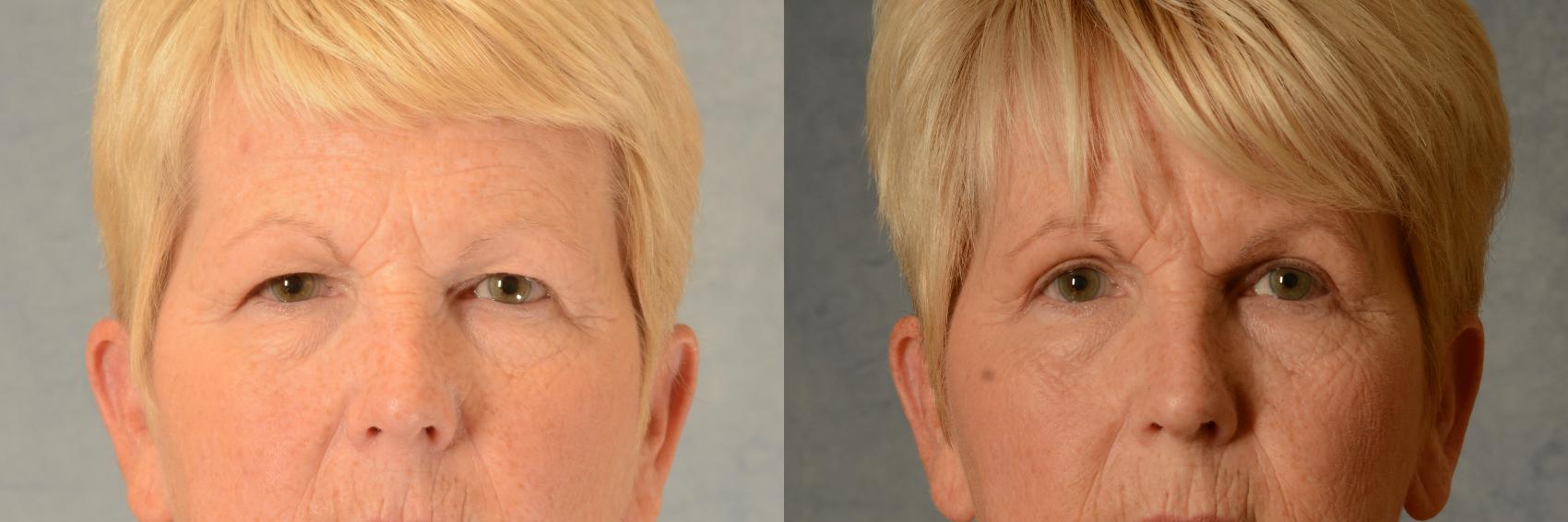 Before & After Eyelid Surgery (Blepharoplasty) Case 512 Front View in Tallahassee, FL