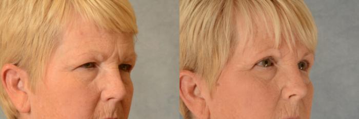 Before & After Eyelid Surgery (Blepharoplasty) Case 512 Right Oblique View in Tallahassee, FL