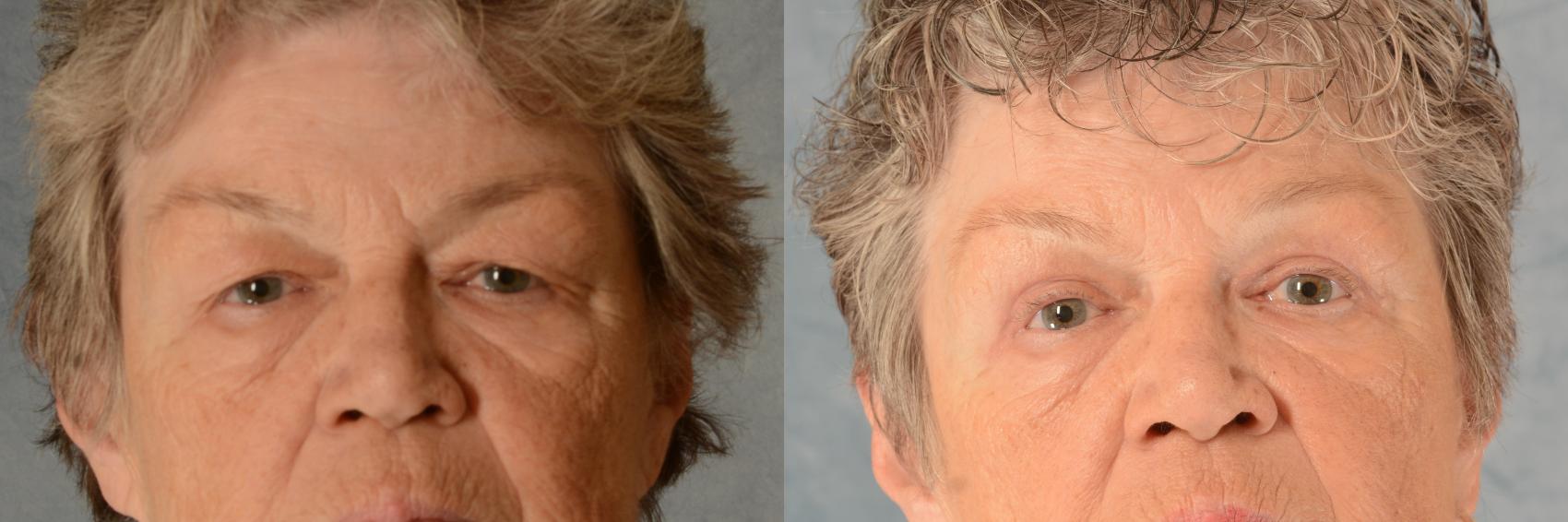Before & After Eyelid Surgery (Blepharoplasty) Case 516 Front View in Tallahassee, FL