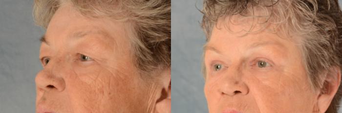 Before & After Eyelid Surgery (Blepharoplasty) Case 516 Left Oblique View in Tallahassee, FL