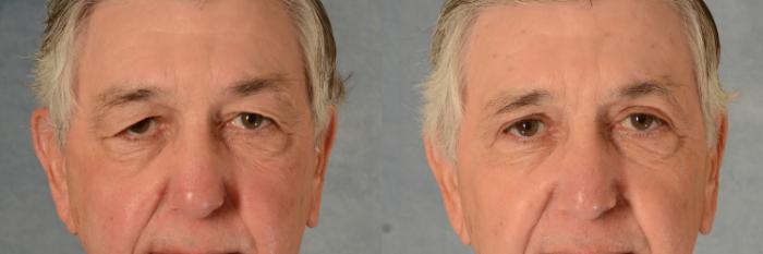Before & After Eyelid Surgery (Blepharoplasty) Case 518 Front View in Tallahassee, FL