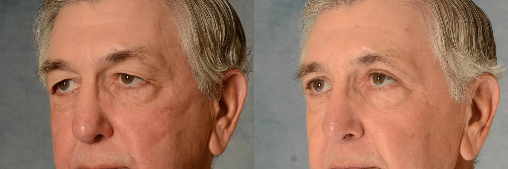 Before & After Eyelid Surgery (Blepharoplasty) Case 518 Left Oblique View in Tallahassee, FL