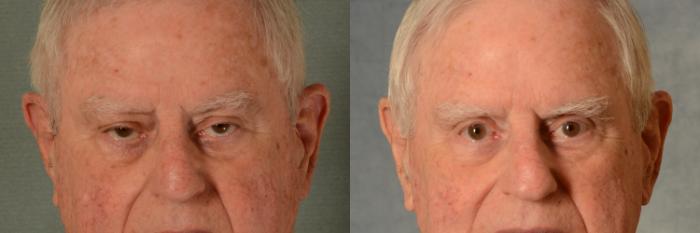 Before & After Eyelid Surgery (Blepharoplasty) Case 519 Front View in Tallahassee, FL