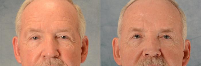 Before & After Eyelid Surgery (Blepharoplasty) Case 520 Front View in Tallahassee, FL