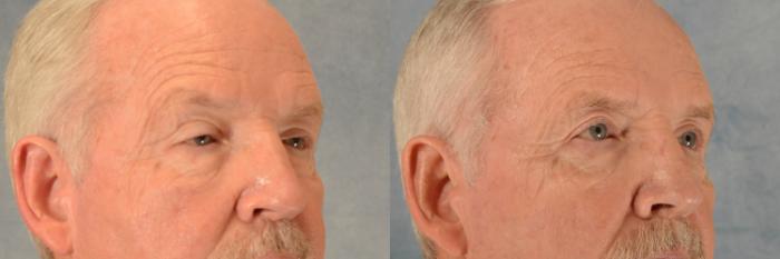 Before & After Eyelid Surgery (Blepharoplasty) Case 520 Right Oblique View in Tallahassee, FL