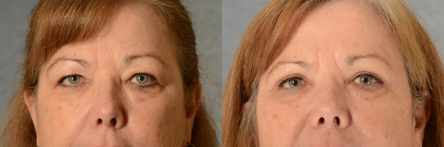 Before & After Eyelid Surgery (Blepharoplasty) Case 523 Front View in Tallahassee, FL