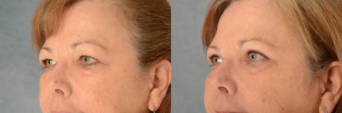 Before & After Eyelid Surgery (Blepharoplasty) Case 523 Left Oblique View in Tallahassee, FL