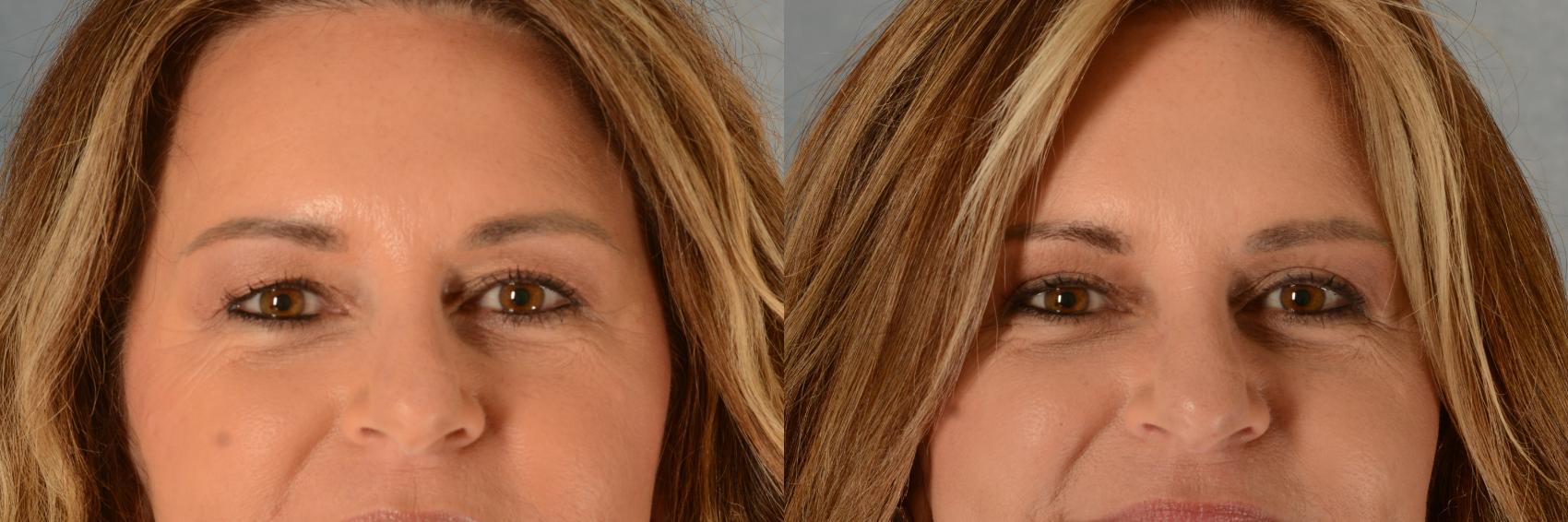 Before & After Eyelid Surgery (Blepharoplasty) Case 527 Front View in Tallahassee, FL
