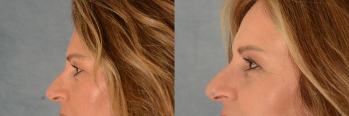 Before & After Eyelid Surgery (Blepharoplasty) Case 527 Left Oblique View in Tallahassee, FL