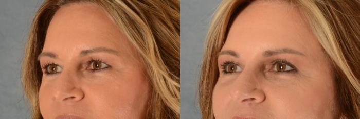 Before & After Eyelid Surgery (Blepharoplasty) Case 527 Left Side View in Tallahassee, FL