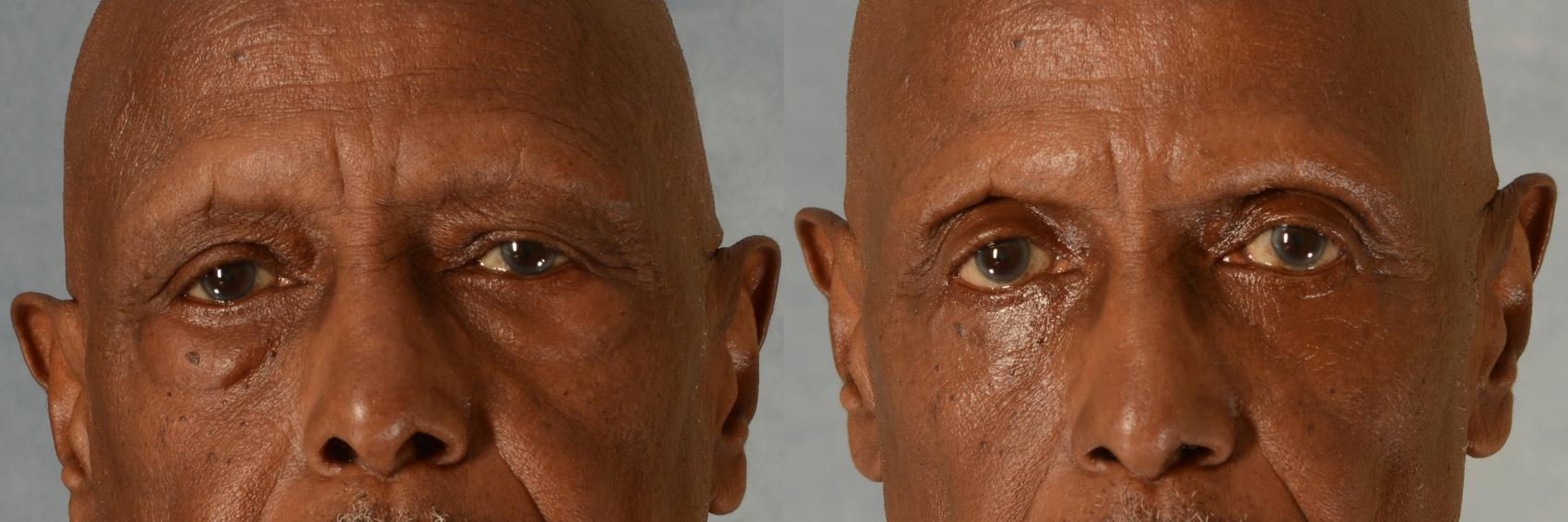 Before & After Eyelid Surgery (Blepharoplasty) Case 536 Front View in Tallahassee, FL
