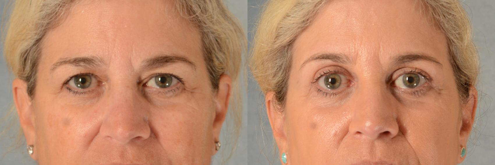 Before & After Eyelid Surgery (Blepharoplasty) Case 544 Front View in Tallahassee, FL