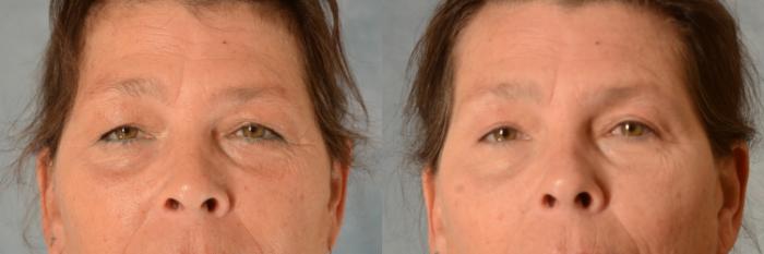 Before & After Eyelid Surgery (Blepharoplasty) Case 547 Front View in Tallahassee, FL
