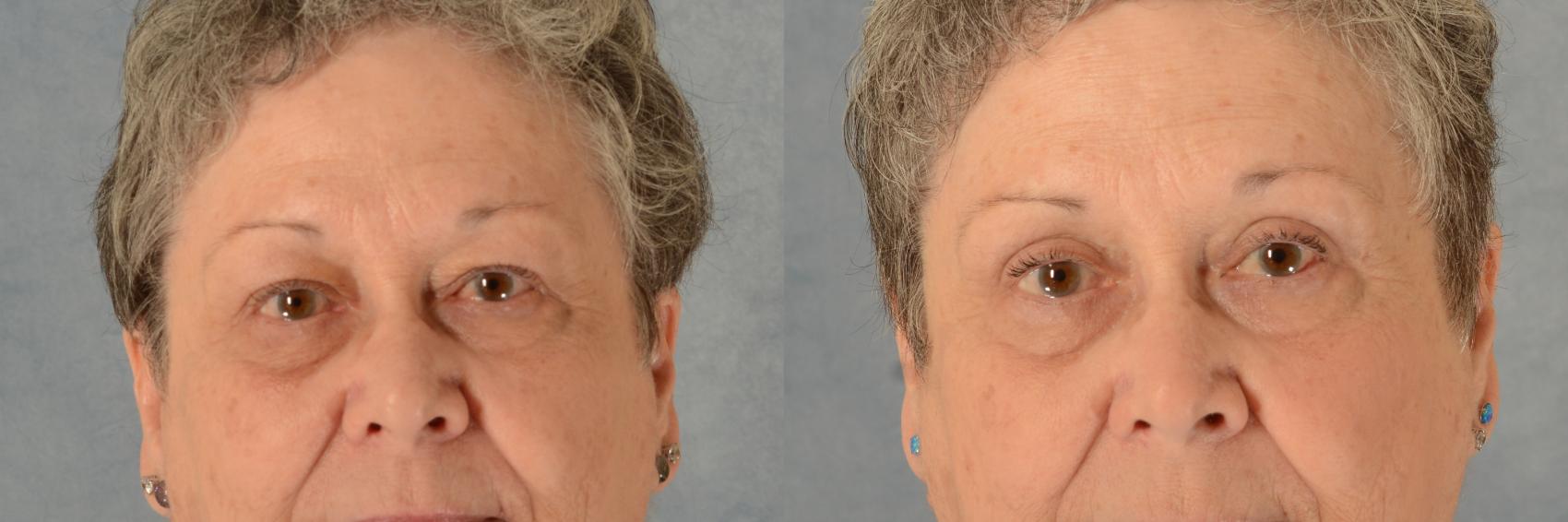 Before & After Eyelid Surgery (Blepharoplasty) Case 548 Front View in Tallahassee, FL