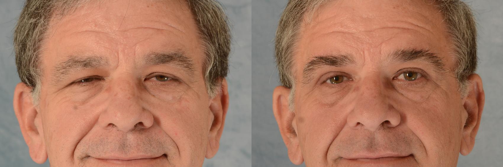 Before & After Eyelid Surgery (Blepharoplasty) Case 549 Front View in Tallahassee, FL