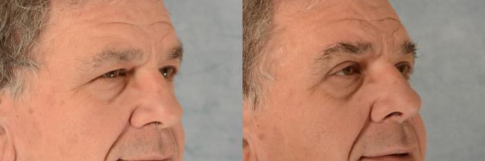 Before & After Eyelid Surgery (Blepharoplasty) Case 549 Right Oblique View in Tallahassee, FL