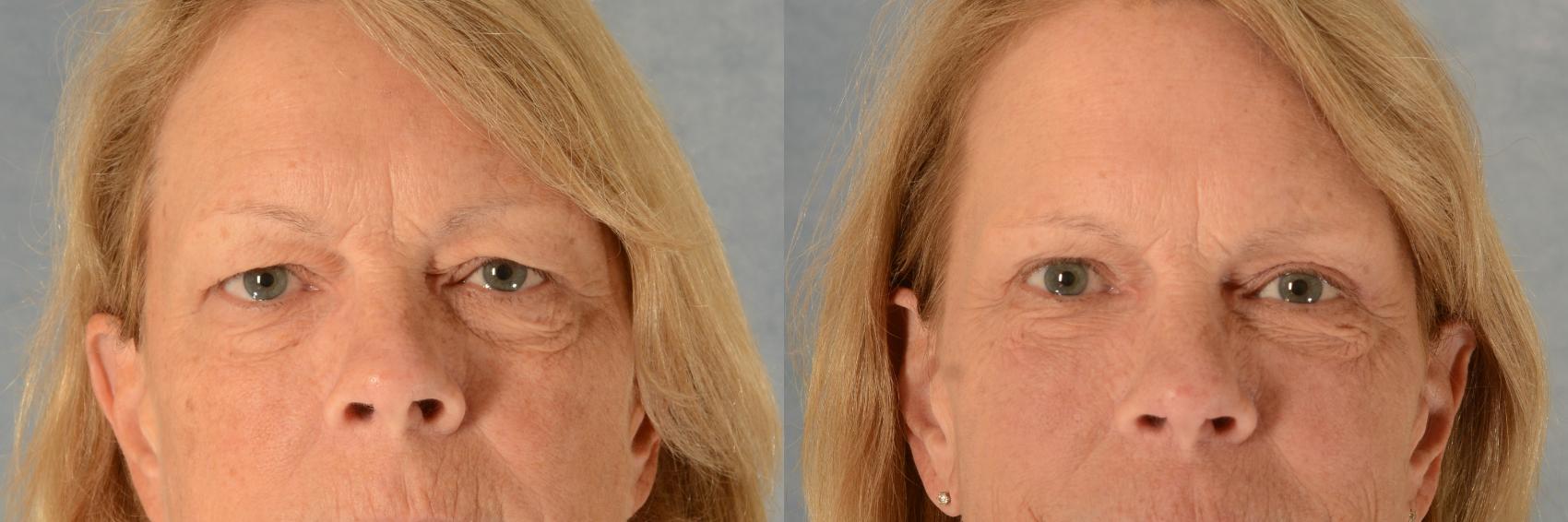 Before & After Eyelid Surgery (Blepharoplasty) Case 550 Front View in Tallahassee, FL