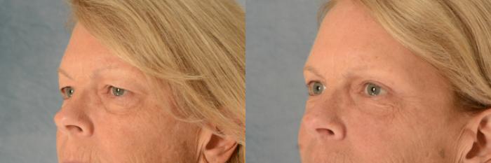 Before & After Eyelid Surgery (Blepharoplasty) Case 550 Left Oblique View in Tallahassee, FL
