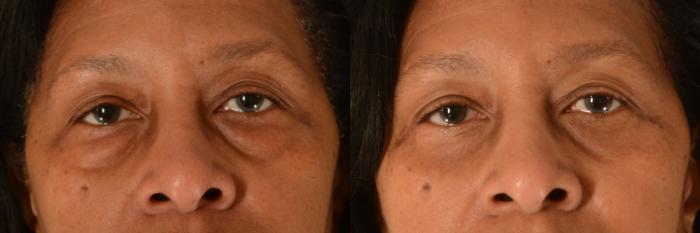 Before & After Eyelid Surgery (Blepharoplasty) Case 556 Front View in Tallahassee, FL