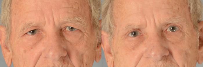Before & After Eyelid Surgery (Blepharoplasty) Case 557 Front View in Tallahassee, FL