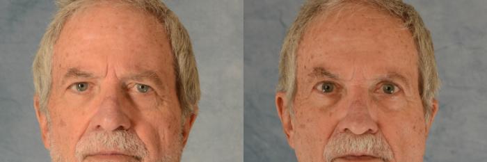 Before & After Eyelid Surgery (Blepharoplasty) Case 563 Front View in Tallahassee, FL