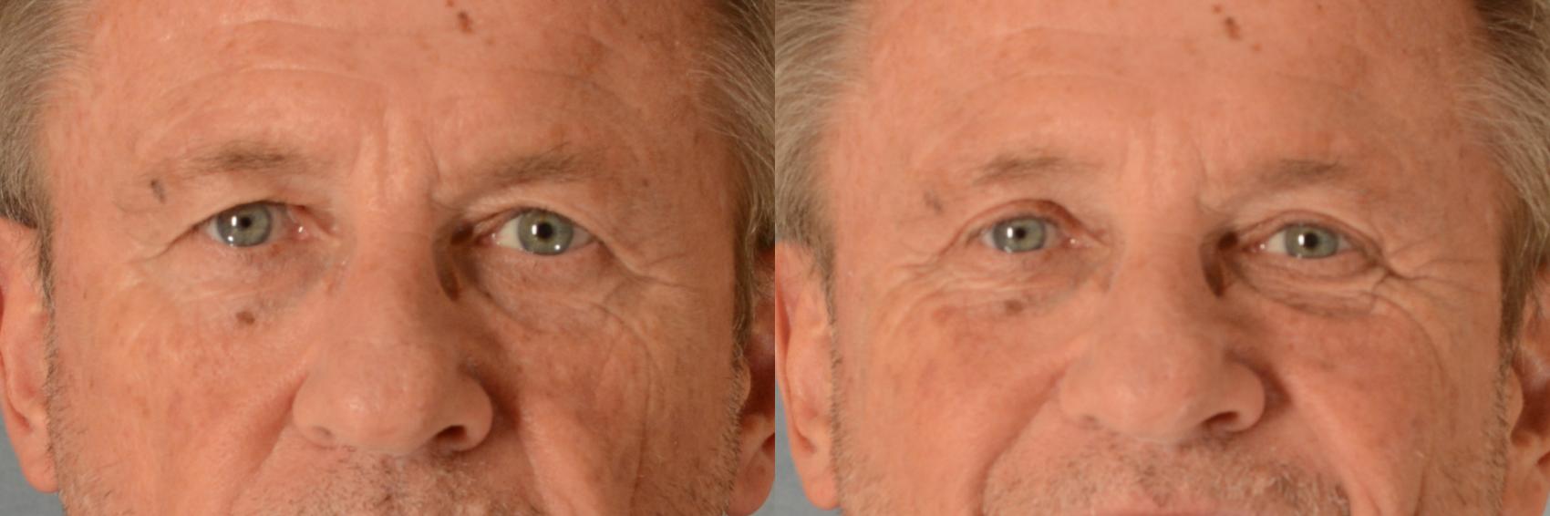 Before & After Eyelid Surgery (Blepharoplasty) Case 565 Front View in Tallahassee, FL