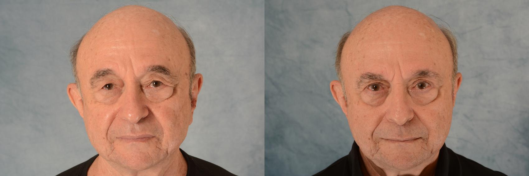 Before & After Eyelid Surgery (Blepharoplasty) Case 580 Front View in Tallahassee, FL