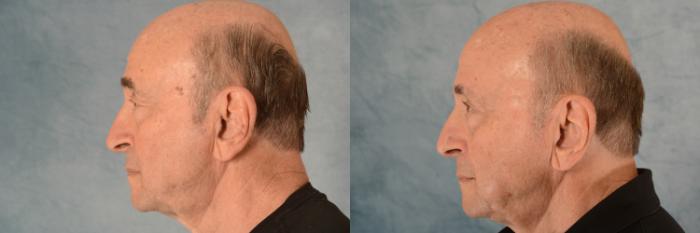 Before & After Eyelid Surgery (Blepharoplasty) Case 580 Left Side View in Tallahassee, FL