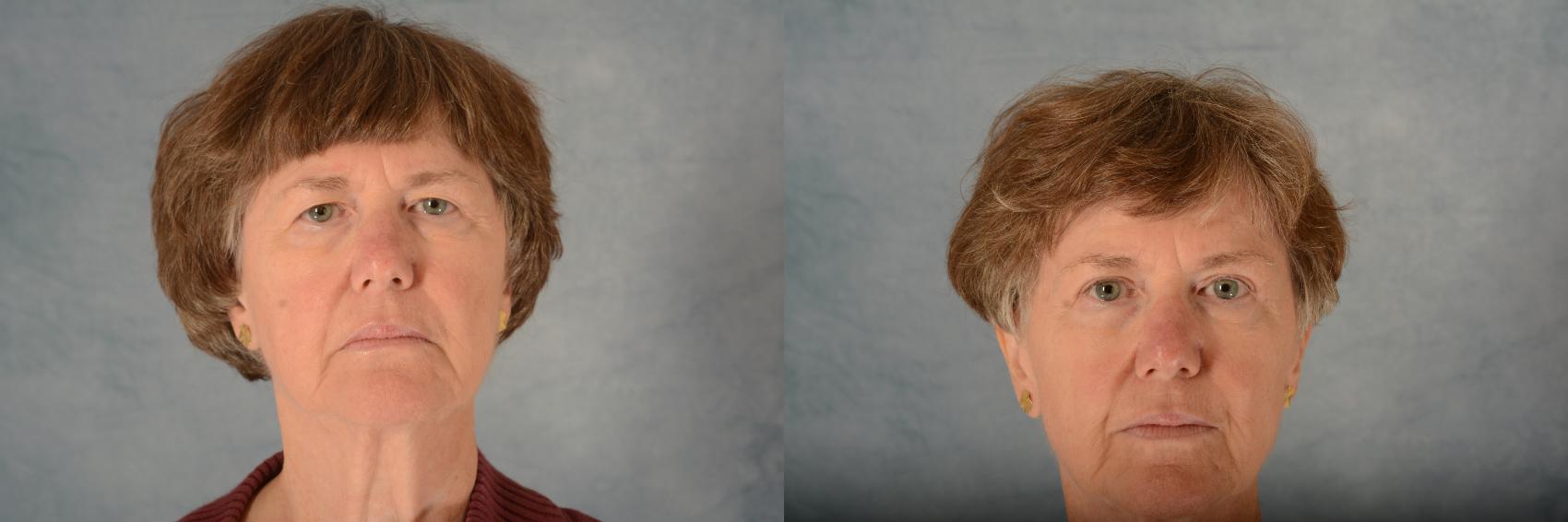 Before & After Eyelid Surgery (Blepharoplasty) Case 584 Front View in Tallahassee, FL