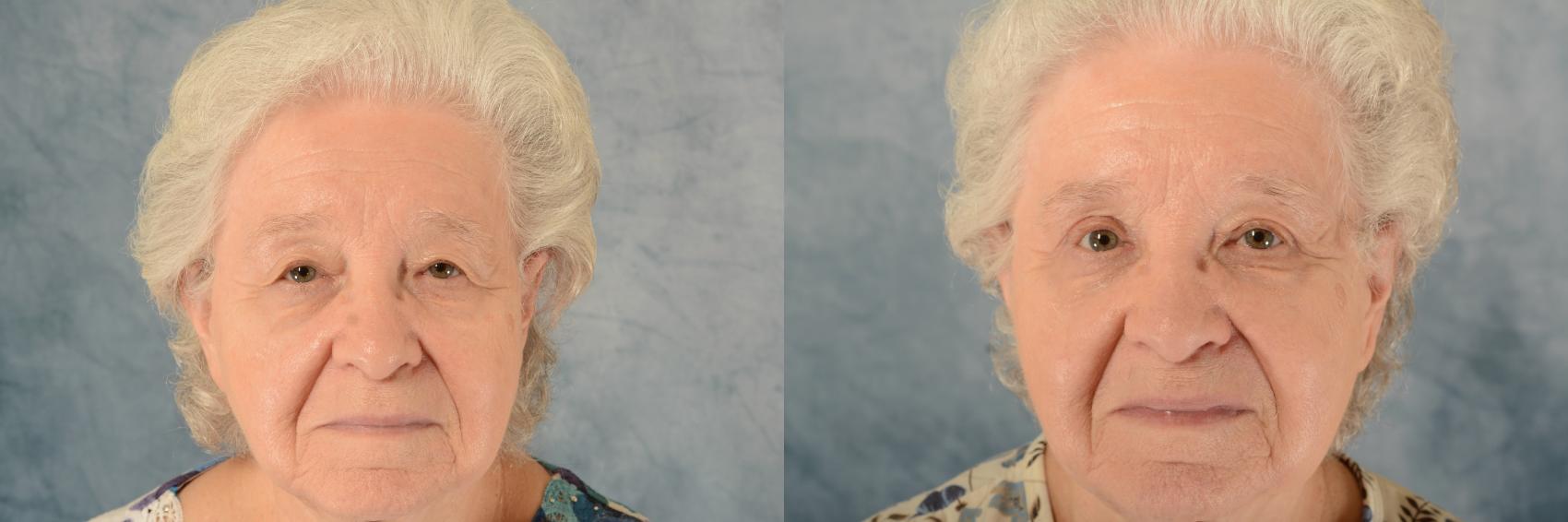 Before & After Eyelid Surgery (Blepharoplasty) Case 591 Front View in Tallahassee, FL