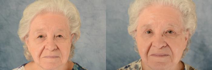 Before & After Eyelid Surgery (Blepharoplasty) Case 591 Front View in Tallahassee, FL