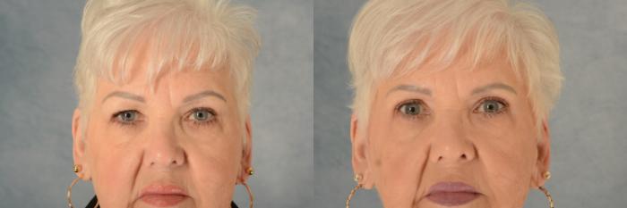 Before & After Eyelid Surgery (Blepharoplasty) Case 593 Front View in Tallahassee, FL