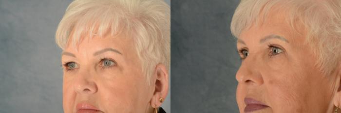 Before & After Eyelid Surgery (Blepharoplasty) Case 593 Left Side View in Tallahassee, FL