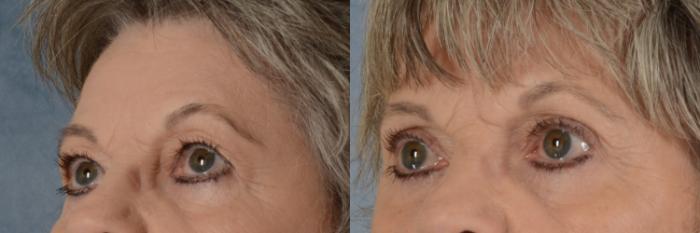 Before & After Eyelid Surgery (Blepharoplasty) Case 603 Left Oblique View in Tallahassee, FL