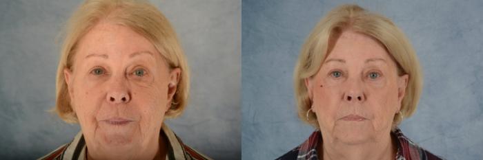 Before & After Eyelid Surgery (Blepharoplasty) Case 604 Front View in Tallahassee, FL