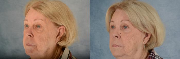 Before & After Eyelid Surgery (Blepharoplasty) Case 604 Left Oblique View in Tallahassee, FL