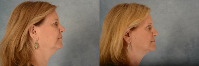 Before & After Eyelid Surgery (Blepharoplasty) Case 609 Right Side View in Tallahassee, FL