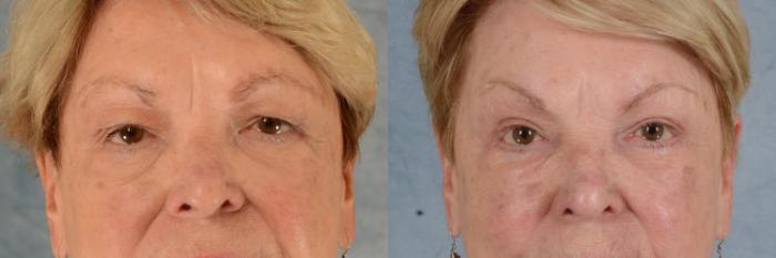 Before & After Eyelid Surgery (Blepharoplasty) Case 610 Front View in Tallahassee, FL