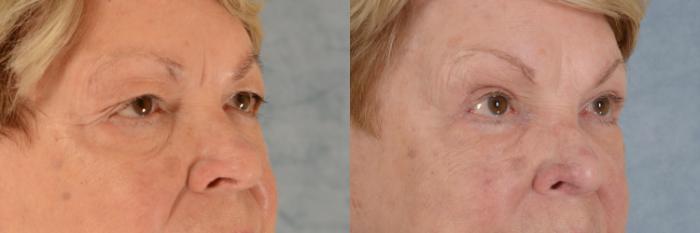 Before & After Eyelid Surgery (Blepharoplasty) Case 610 Right Oblique View in Tallahassee, FL