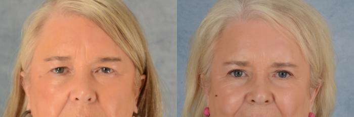 Before & After Eyelid Surgery (Blepharoplasty) Case 613 Front View in Tallahassee, FL