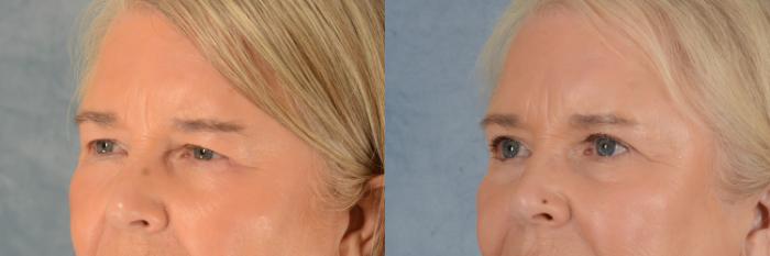 Before & After Eyelid Surgery (Blepharoplasty) Case 613 Left Oblique View in Tallahassee, FL