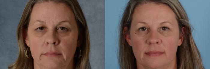 Before & After Eyelid Surgery (Blepharoplasty) Case 651 Front View in Tallahassee, FL