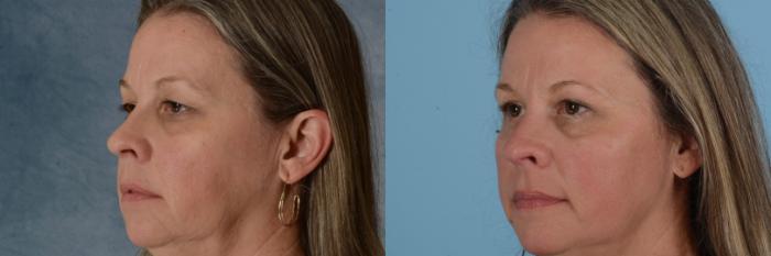 Before & After Eyelid Surgery (Blepharoplasty) Case 651 Left Oblique View in Tallahassee, FL