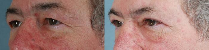 Before & After Eyelid Surgery (Blepharoplasty) Case 66 View #2 View in Tallahassee, FL