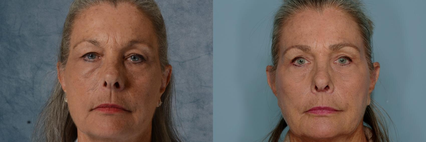 Before & After Eyelid Surgery (Blepharoplasty) Case 661 Front View in Tallahassee, FL