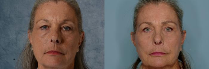 Before & After Eyelid Surgery (Blepharoplasty) Case 661 Front View in Tallahassee, FL