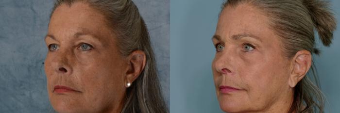 Before & After Eyelid Surgery (Blepharoplasty) Case 661 Left Oblique View in Tallahassee, FL