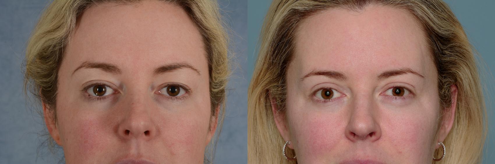 Before & After Eyelid Surgery (Blepharoplasty) Case 673 Front View in Tallahassee, FL