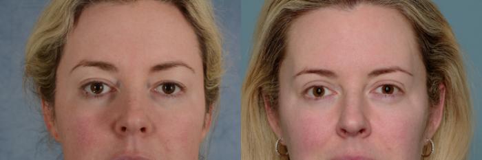 Before & After Eyelid Surgery (Blepharoplasty) Case 673 Front View in Tallahassee, FL